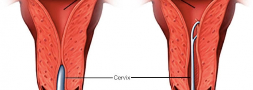 Terapotik Kürtaj Nedir?
