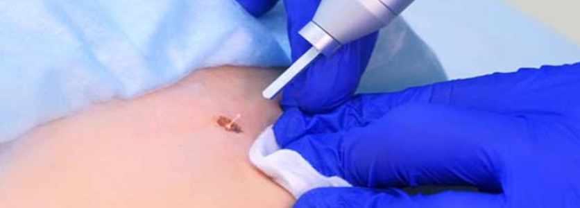 Genital Siğil Tedavisi