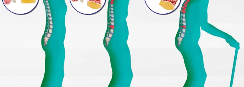 Osteoporoz Kemik Erimesi Neden Olur?