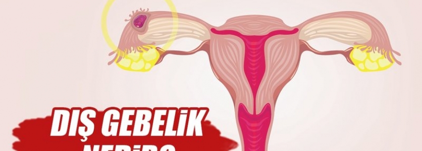 Dış Gebelik Nedir, Nasıl Anlaşılır, Belirtileri Nelerdir?
