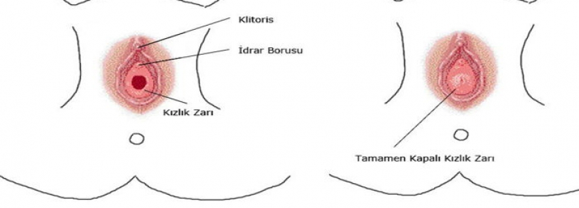 Geçici Kızlık Zarı Dikimi