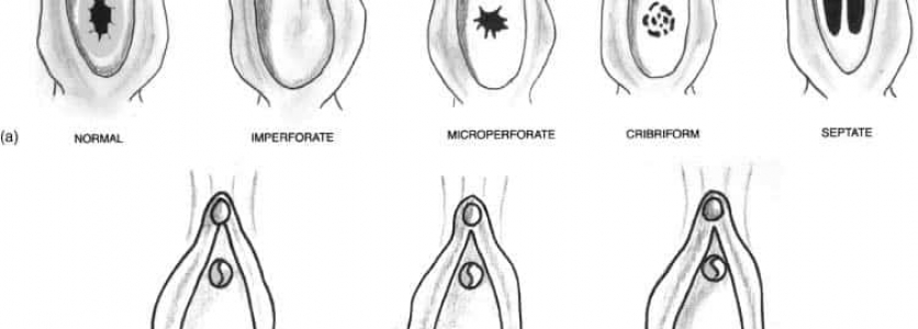 Flep Yöntemiyle Kızlık Zarı Dikimi